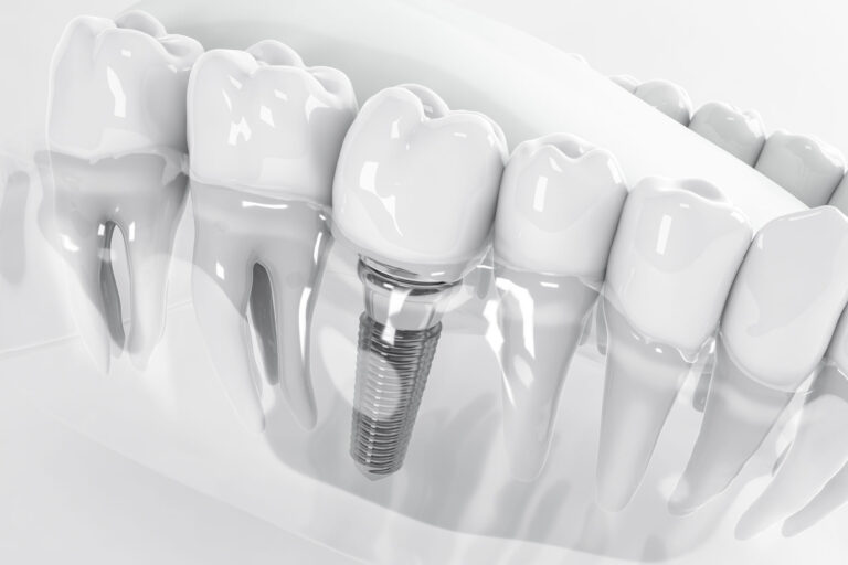 alternative-to-dental-implants