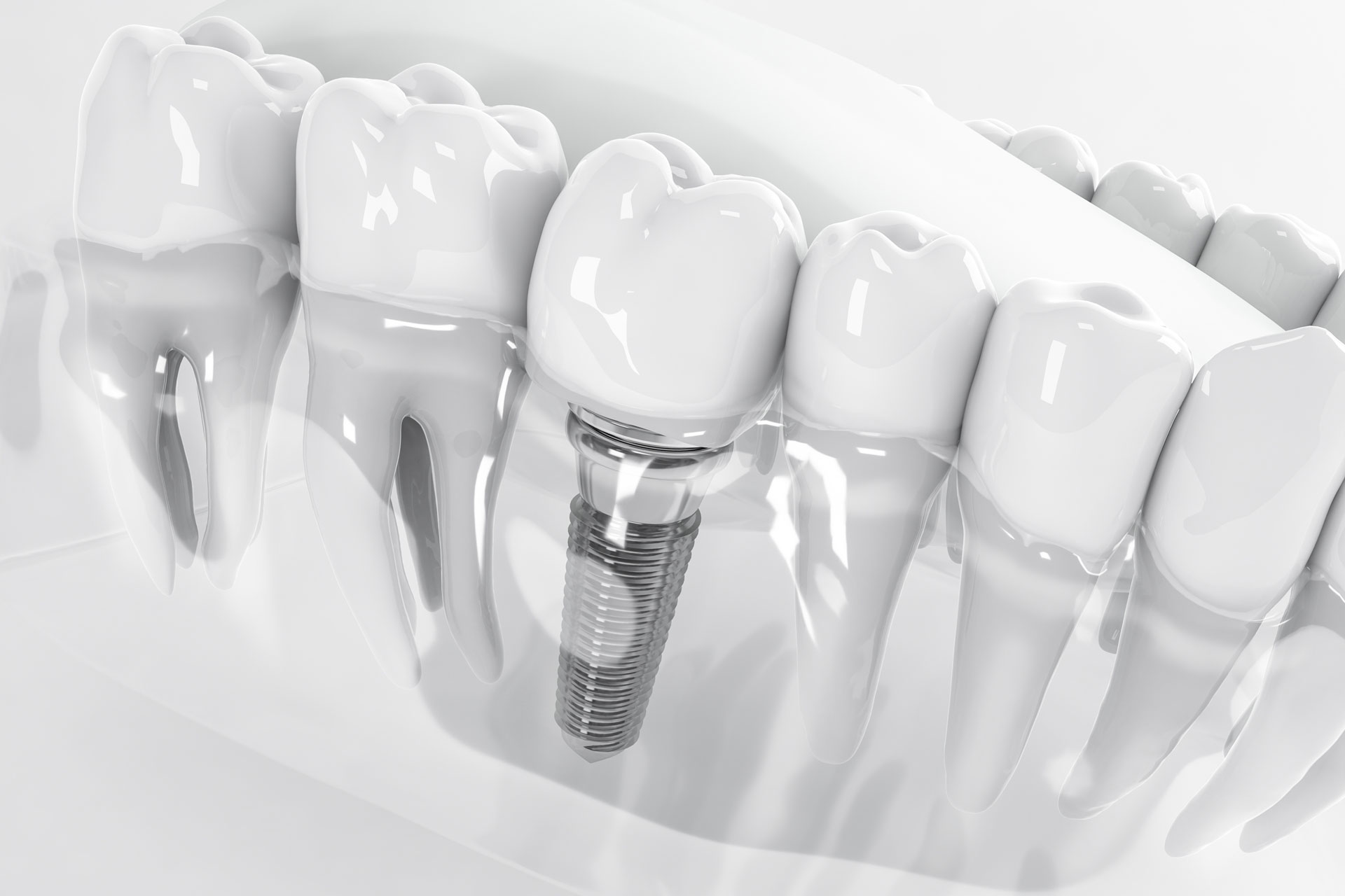 Are there alternatives to tooth implants?