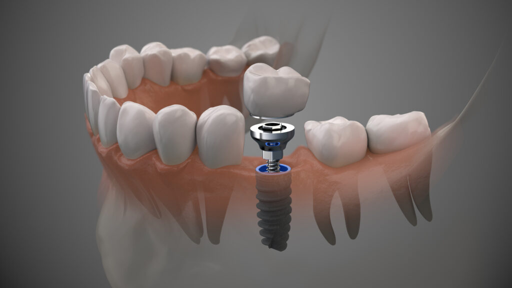 dental implants singapore